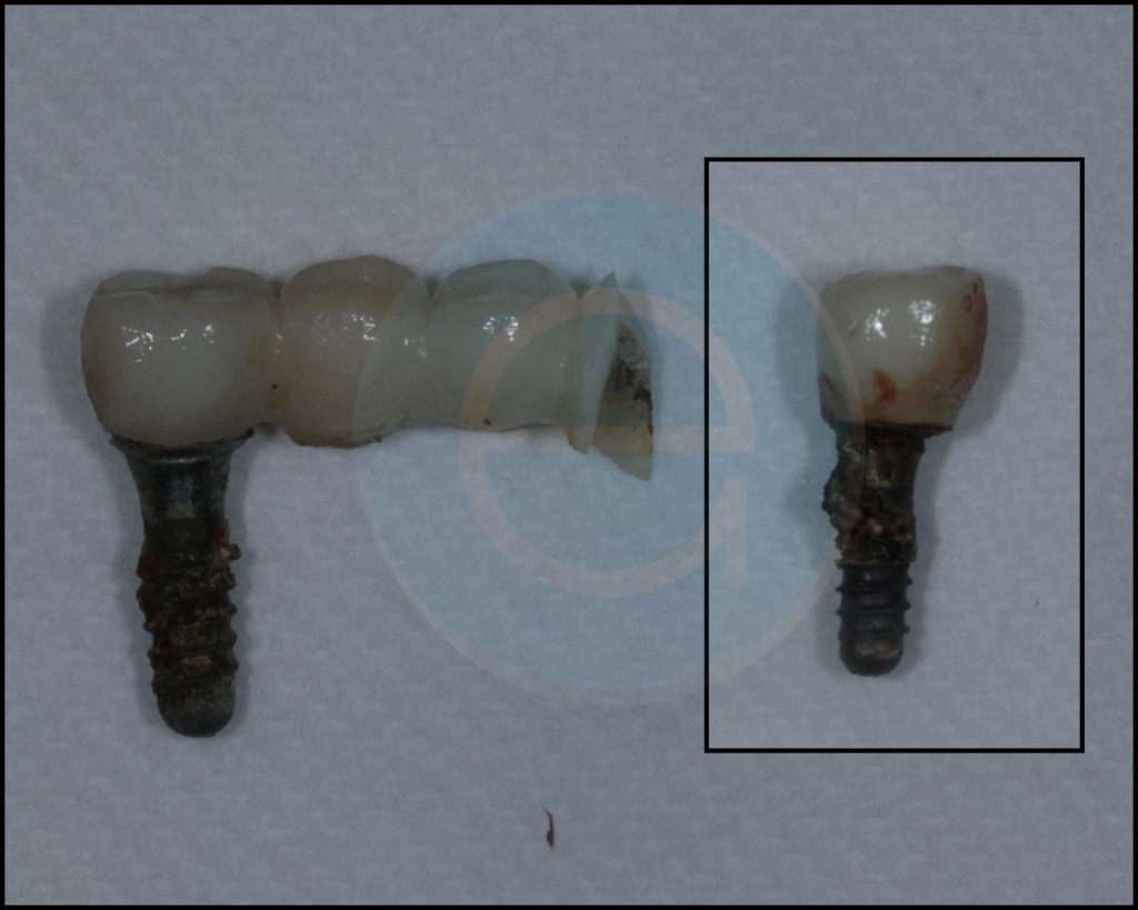 Başarısız İmplant Belirtileri Nelerdir?