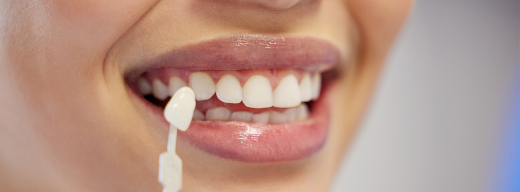 Dental Veneer