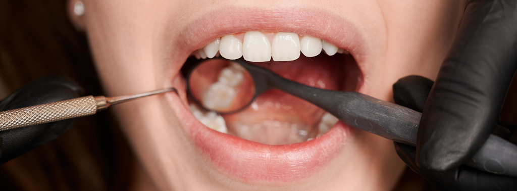 Dental Stone Cleaning